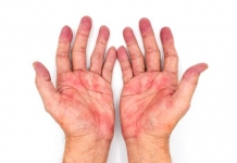 تشخیص بیماری کبد از روی قرمزی کف دست