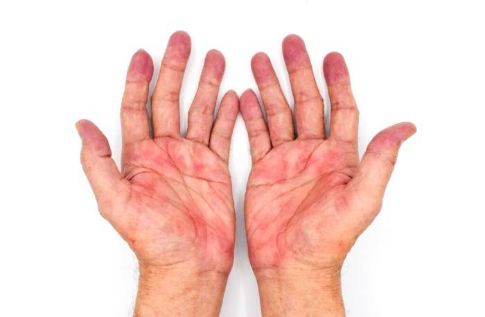 تشخیص بیماری کبد از روی قرمزی کف دست