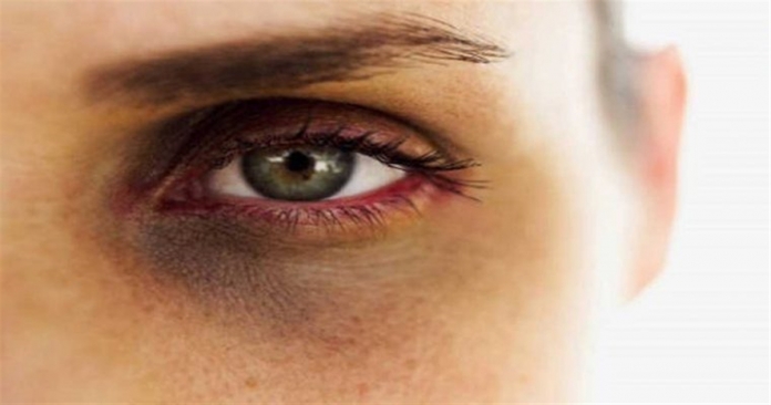 7 راهکار برای رفع سیاهی دور چشم