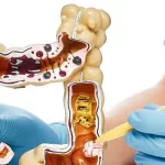 پیوند میکروبیوتای مدفوع