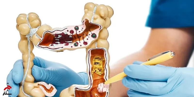 پیوند میکروبیوتای مدفوع